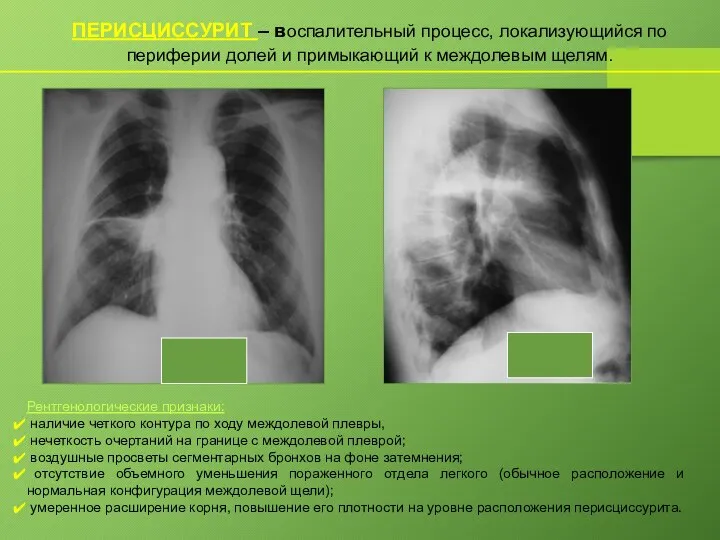 ПЕРИСЦИССУРИТ – воспалительный процесс, локализующийся по периферии долей и примыкающий к междолевым