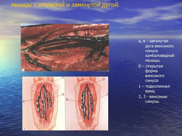 Магистральная форма венозного синуса камбаловидной мышцы с открытой и замкнутой дугой. а,