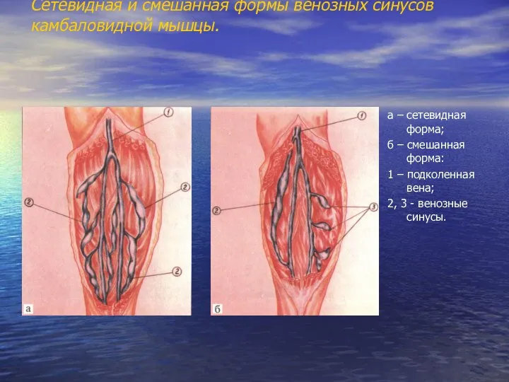 Сетевидная и смешанная формы венозных синусов камбаловидной мышцы. а – сетевидная форма;