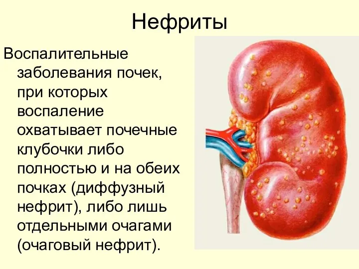 Нефриты Воспалительные заболевания почек, при которых воспаление охватывает почечные клубочки либо полностью