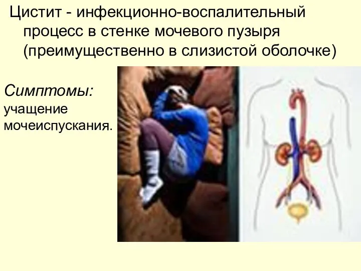 Цистит - инфекционно-воспалительный процесс в стенке мочевого пузыря (преимущественно в слизистой оболочке) Симптомы: учащение мочеиспускания.