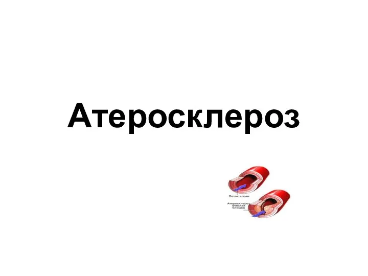 Атеросклероз