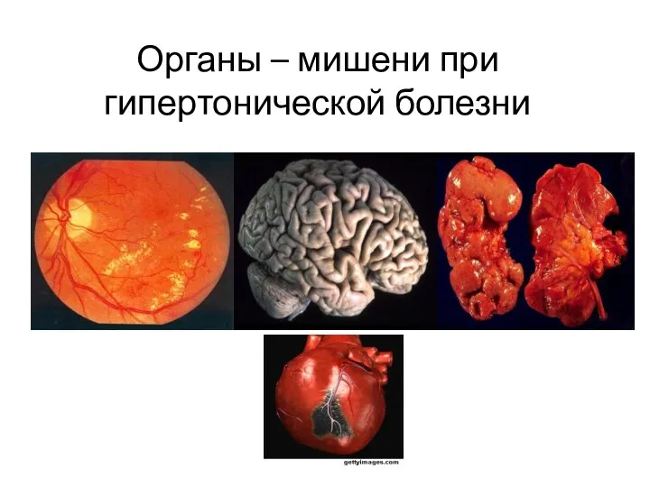 Органы – мишени при гипертонической болезни