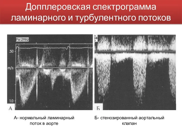 Допплеровская спектрограмма ламинарного и турбулентного потоков А- нормальный ламинарный поток в аорте Б- стенозированный аортальный клапан