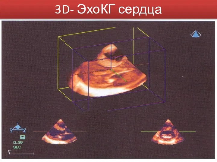 3D- ЭхоКГ сердца
