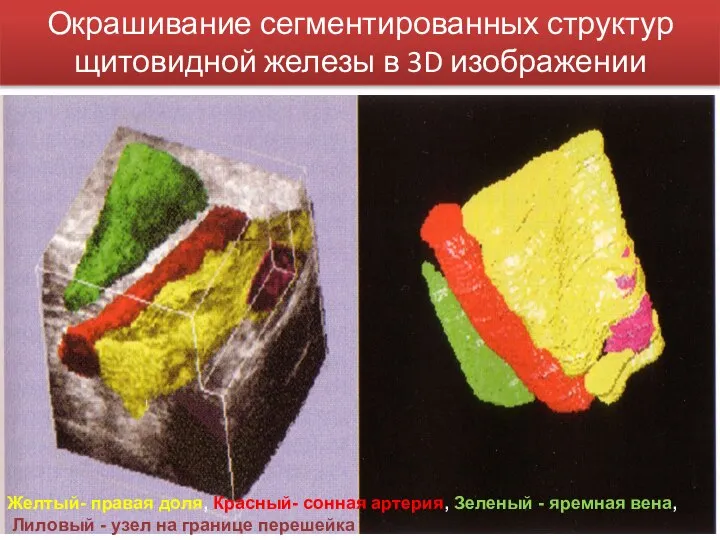 Окрашивание сегментированных структур щитовидной железы в 3D изображении Желтый- правая доля, Красный-