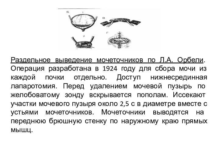 Раздельное выведение мочеточников по Л.А. Орбели. Операция разработана в 1924 году для