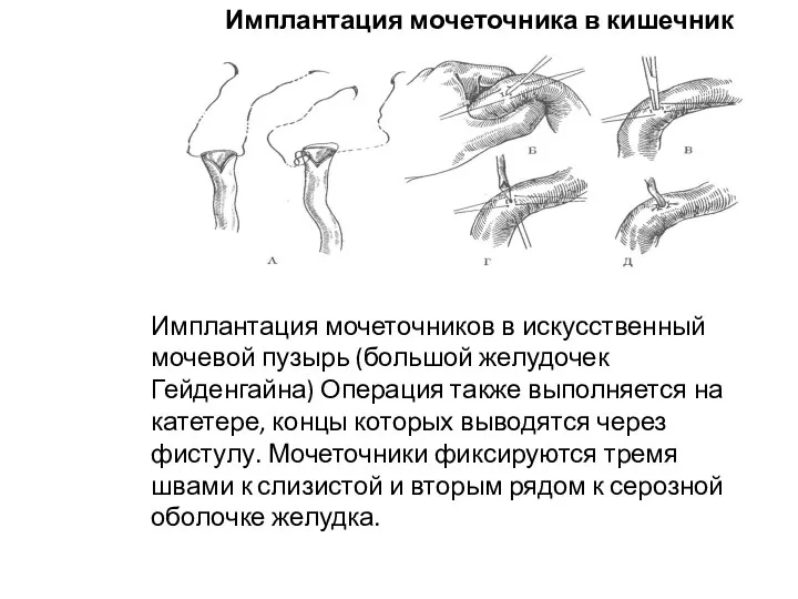 Имплантация мочеточника в кишечник Имплантация мочеточников в искусственный мочевой пузырь (большой желудочек