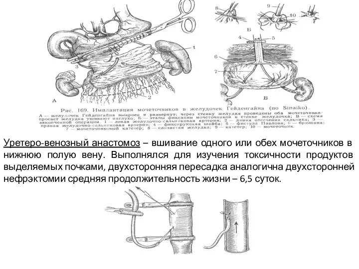 Уретеро-венозный анастомоз – вшивание одного или обех мочеточников в нижнюю полую вену.