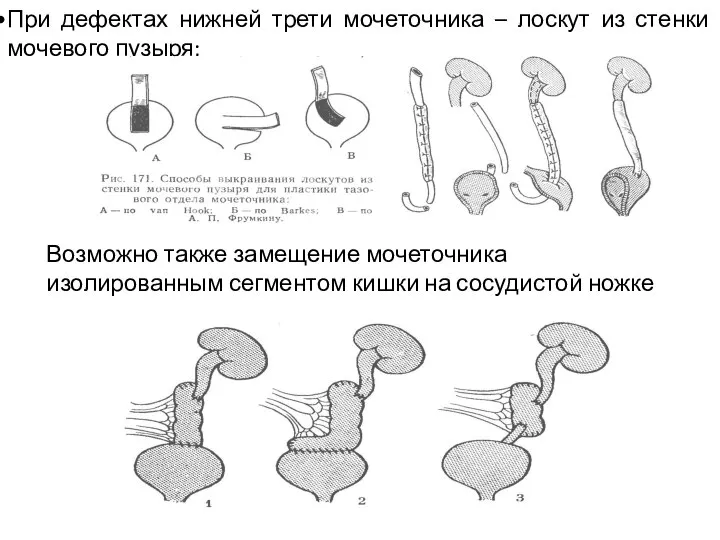 При дефектах нижней трети мочеточника – лоскут из стенки мочевого пузыря; Возможно