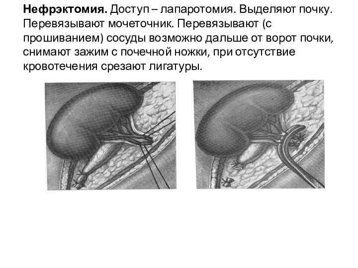 Нефрэктомия. Доступ – лапаротомия. Выделяют почку. Перевязывают мочеточник. Перевязывают (с прошиванием) сосуды