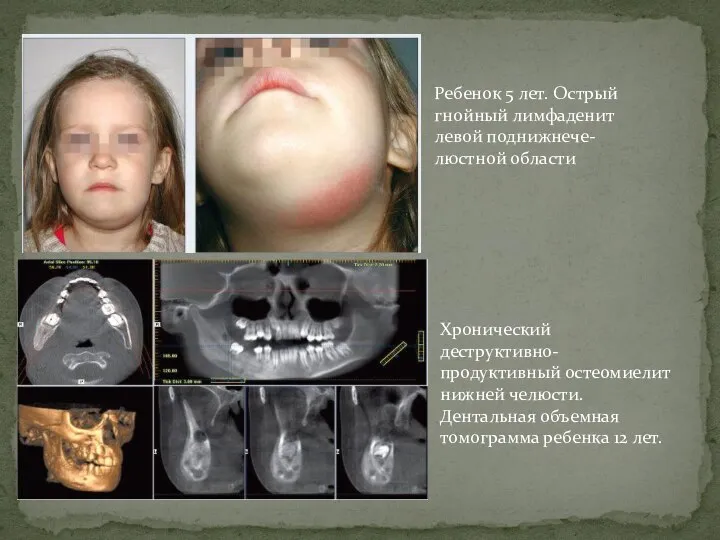 Хронический деструктивно-продуктивный остеомиелит нижней челюсти. Дентальная объемная томограмма ребенка 12 лет. Ребенок