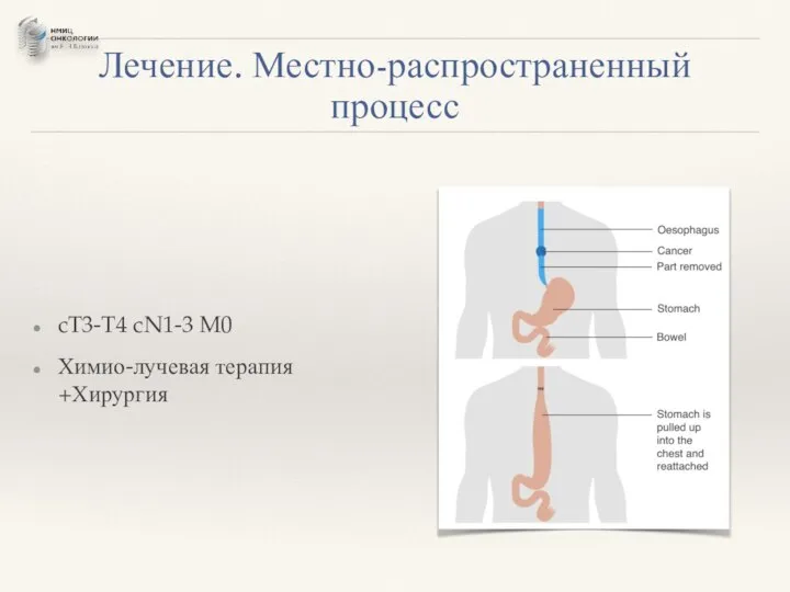 Лечение. Местно-распространенный процесс cT3-T4 cN1-3 M0 Химио-лучевая терапия +Хирургия