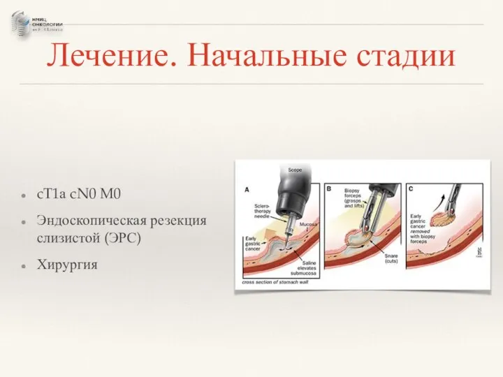 Лечение. Начальные стадии cT1а cN0 M0 Эндоскопическая резекция слизистой (ЭРС) Хирургия