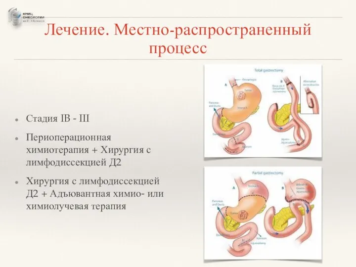 Лечение. Местно-распространенный процесс Стадия IB - III Периоперационная химиотерапия + Хирургия с