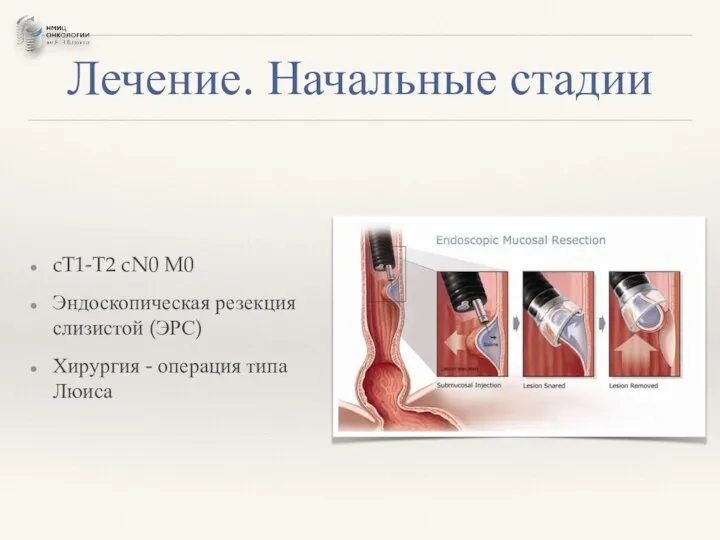 Лечение. Начальные стадии cT1-T2 cN0 M0 Эндоскопическая резекция слизистой (ЭРС) Хирургия - операция типа Люиса