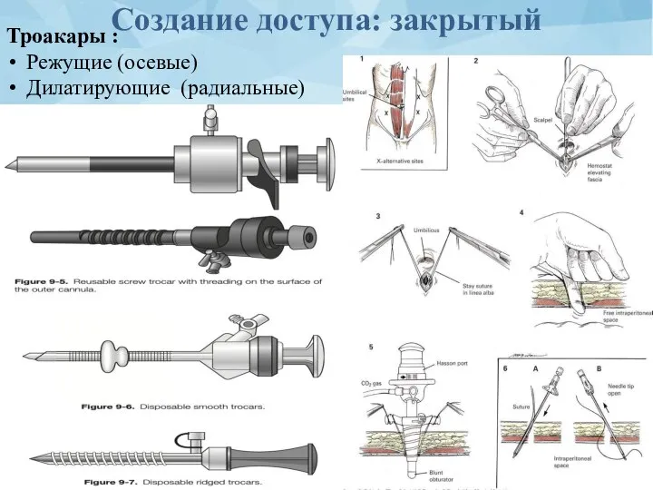 Создание доступа: закрытый Троакары : Режущие (осевые) Дилатирующие (радиальные)