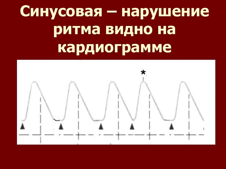 Синусовая – нарушение ритма видно на кардиограмме