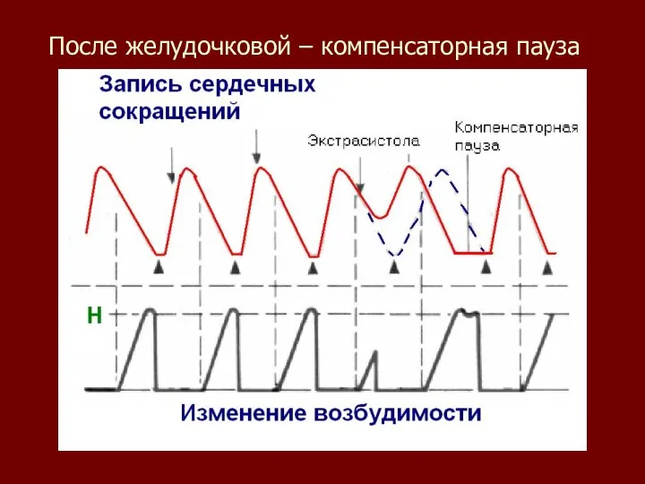 После желудочковой – компенсаторная пауза