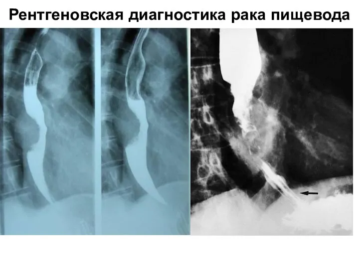 Рентгеновская диагностика рака пищевода