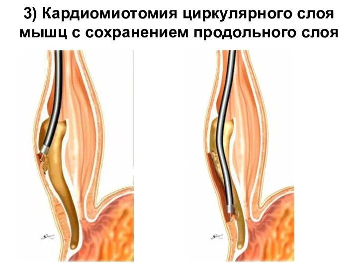 3) Кардиомиотомия циркулярного слоя мышц с сохранением продольного слоя