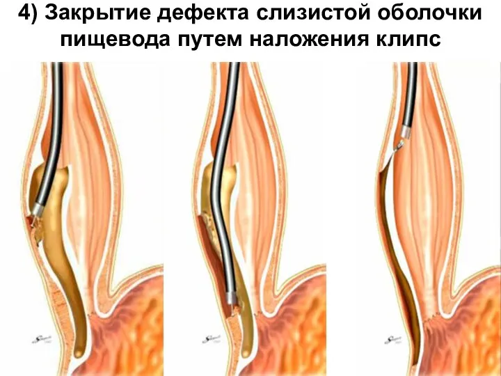 4) Закрытие дефекта слизистой оболочки пищевода путем наложения клипс