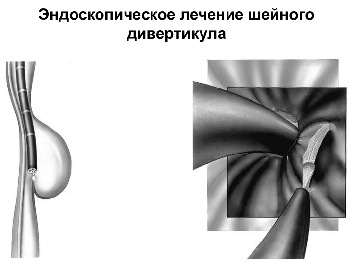 Эндоскопическое лечение шейного дивертикула