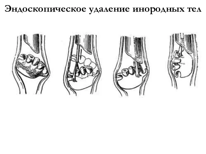 Эндоскопическое удаление инородных тел