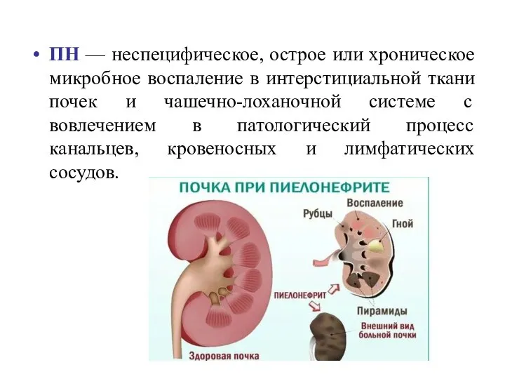 ПН — неспецифическое, острое или хроническое микробное воспаление в интерстициальной ткани почек