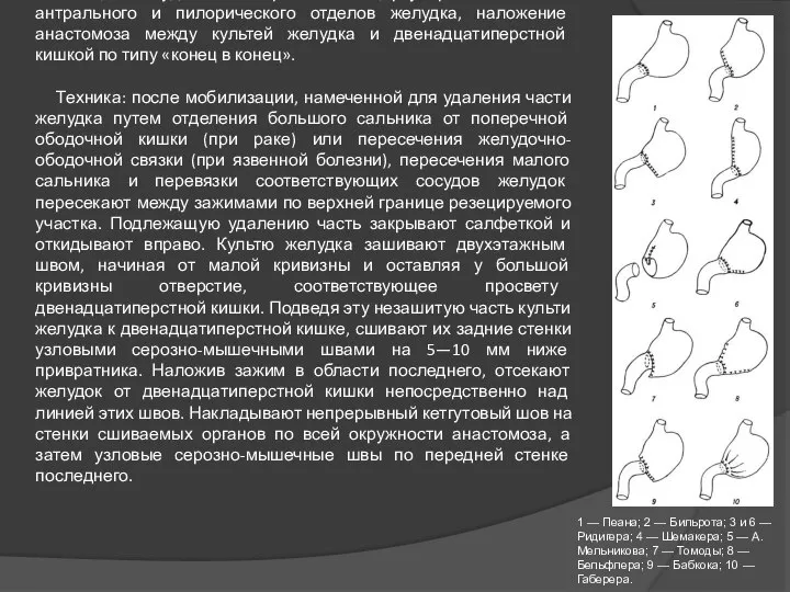 Резекция желудка по Бильрот 1 Резекции желудка по Бильрот 1 – это