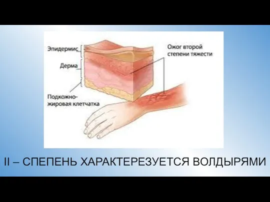 II – СПЕПЕНЬ ХАРАКТЕРЕЗУЕТСЯ ВОЛДЫРЯМИ