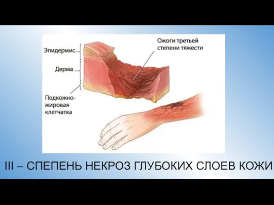 III – СПЕПЕНЬ НЕКРОЗ ГЛУБОКИХ СЛОЕВ КОЖИ