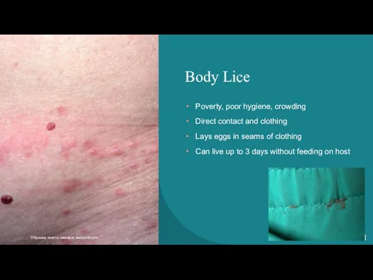 Body Lice Poverty, poor hygiene, crowding Direct contact and clothing Lays eggs