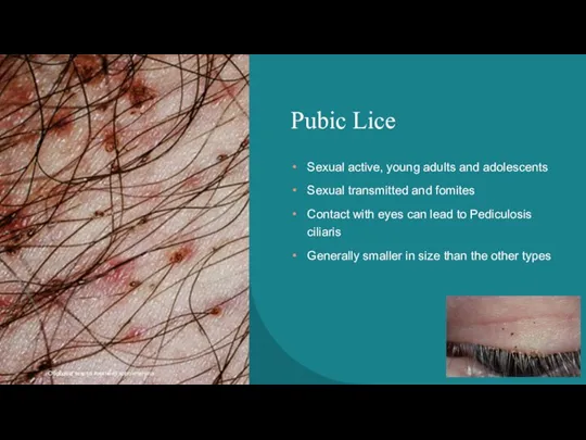 Pubic Lice Sexual active, young adults and adolescents Sexual transmitted and fomites