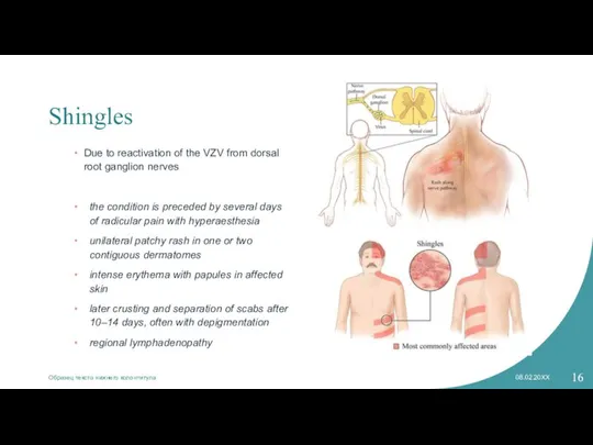 Shingles Due to reactivation of the VZV from dorsal root ganglion nerves