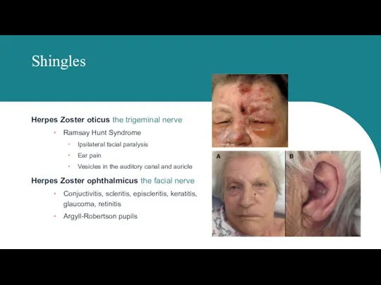 Shingles Herpes Zoster oticus the trigeminal nerve Ramsay Hunt Syndrome Ipsilateral facial