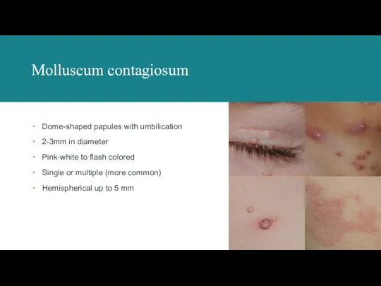 Molluscum contagiosum Dome-shaped papules with umbilication 2-3mm in diameter Pink-white to flash