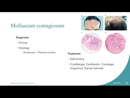 Molluscum contagiosum Diagnosis Clinical Histology Henderson – Peterson bodies Treatment Self-limiting Cryotherapy,