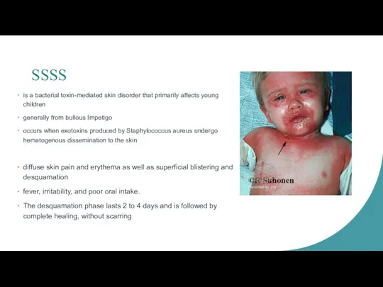 SSSS is a bacterial toxin-mediated skin disorder that primarily affects young children