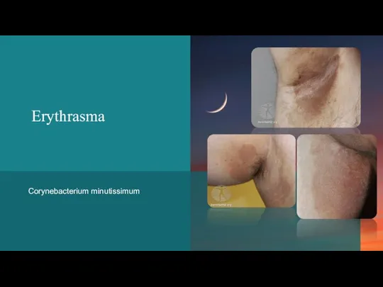 Erythrasma Corynebacterium minutissimum