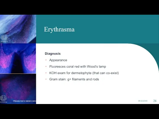 Erythrasma Diagnosis Appearance Fluoresces coral red with Wood’s lamp KOH exam for