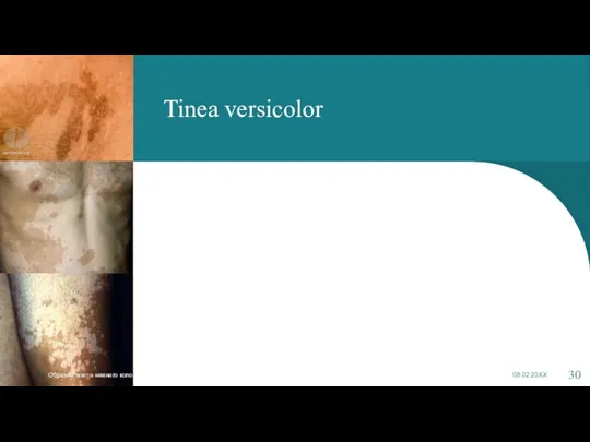 Tinea versicolor Образец текста нижнего колонтитула 08.02.20XX