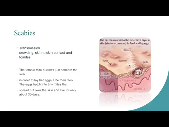 Scabies Transmission crowding, skin to skin contact and fomites The female mite