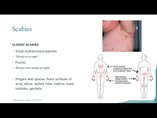 Scabies CLASSIC SCABIES Small erythematous papules “Knots on a rope” Pruritic Severe