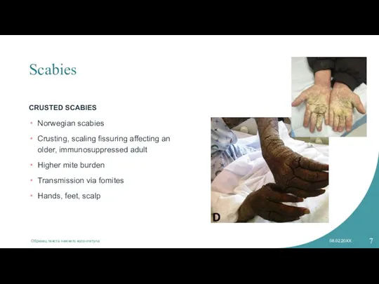 Scabies CRUSTED SCABIES Образец текста нижнего колонтитула 08.02.20XX Norwegian scabies Crusting, scaling