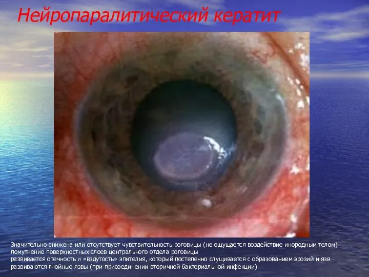 Нейропаралитический кератит Значительно снижена или отсутствует чувствительность роговицы (не ощущается воздействие инородным