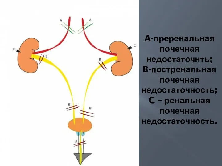 A-преренальная почечная недостаточнть; B-постренальная почечная недостаточность; C – ренальная почечная недостаточность.