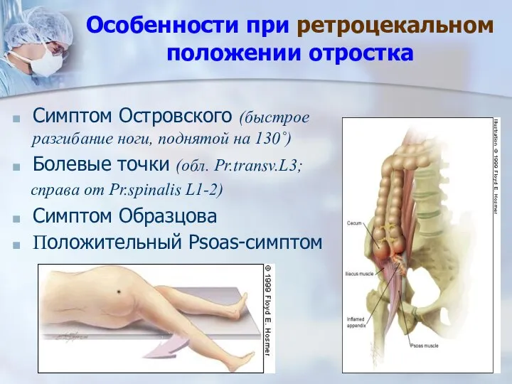 Особенности при ретроцекальном положении отростка Симптом Островского (быстрое разгибание ноги, поднятой на