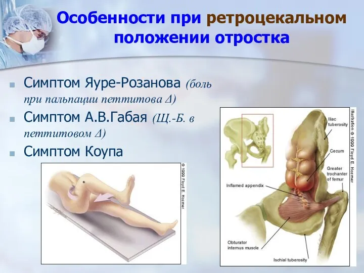 Особенности при ретроцекальном положении отростка Симптом Яуре-Розанова (боль при пальпации петтитова Δ)