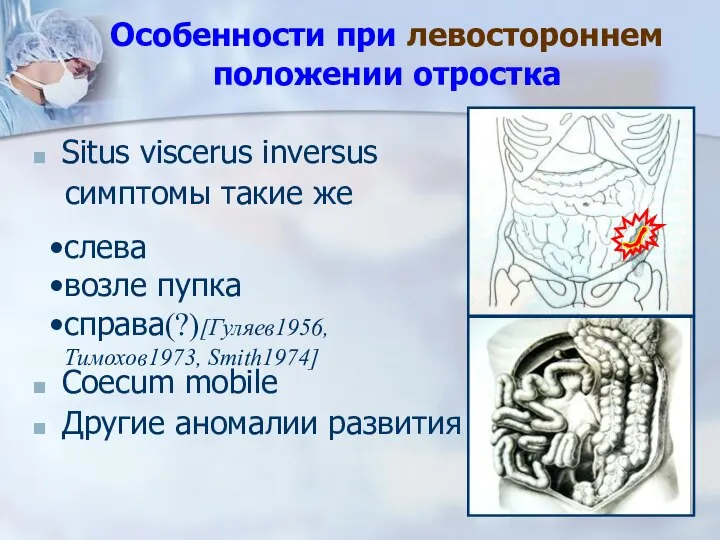 Особенности при левостороннем положении отростка Situs viscerus inversus симптомы такие же Coecum